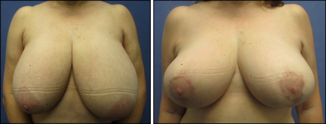 BreastReduction